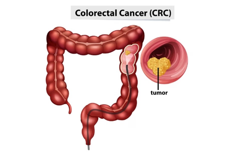 sel abnormal kanker usus