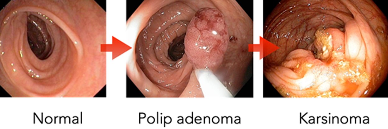 Gambar 1. Perjalanan usus besar dari normal hingga tumbuh polip adenoma, dan dalam kurun waktu 10-15 tahun dapat tumbuh menjadi kanker usus besar